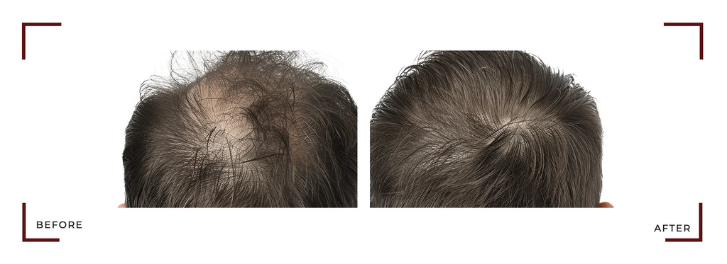 Capixy Anti Hair Loss Vials 70ml