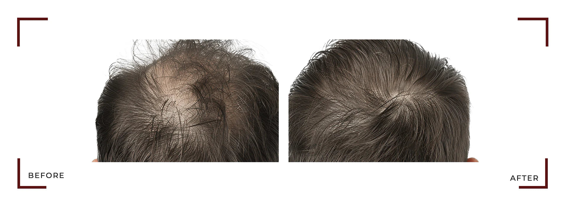 Capixy Anti Hair Loss Vials 70ml